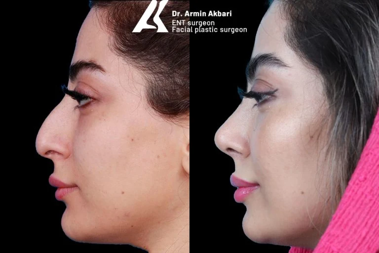 Rhinoplasty before and after comparison, example 12, published by Dr Armin Akbari