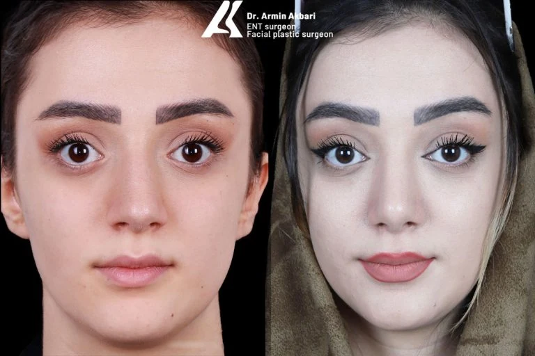 Rhinoplasty before and after comparison, example 13, published by Dr Armin Akbari