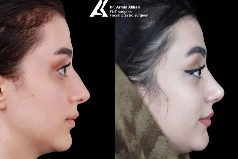 Rhinoplasty before and after comparison, example 14, published by Dr Armin Akbari