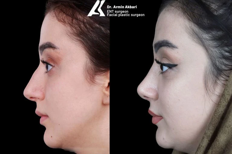 Rhinoplasty before and after comparison, example 15, published by Dr Armin Akbari