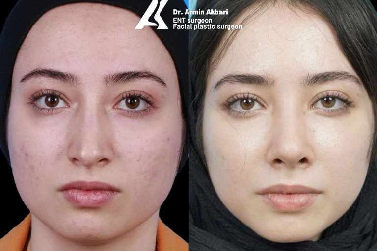 Rhinoplasty before and after comparison, example 16, published by Dr Armin Akbari