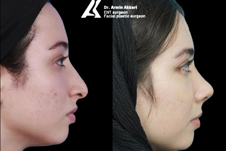 Rhinoplasty before and after comparison, example 17, published by Dr Armin Akbari