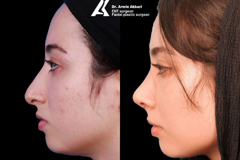 Rhinoplasty before and after comparison, example 18, published by Dr Armin Akbari