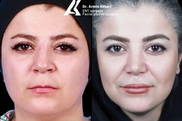 Rhinoplasty before and after comparison, example 19, published by Dr Armin Akbari