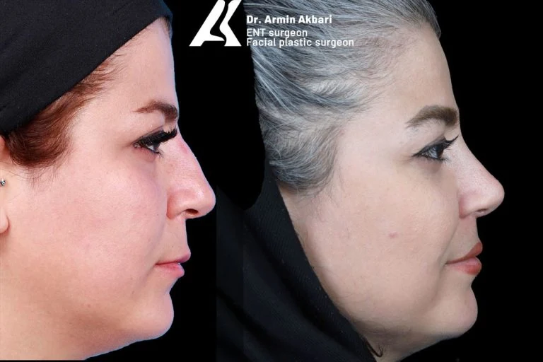 Rhinoplasty before and after comparison, example 20, published by Dr Armin Akbari