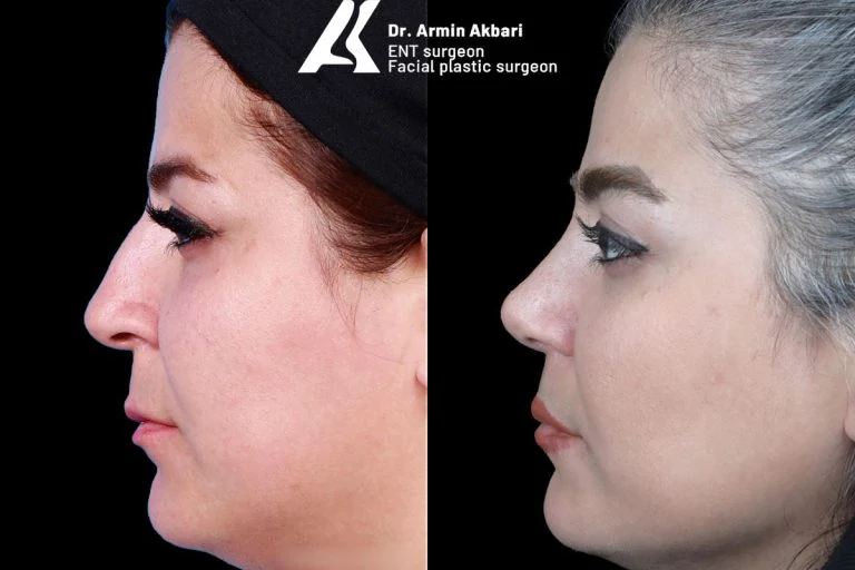 Rhinoplasty before and after comparison, example 21, published by Dr Armin Akbari