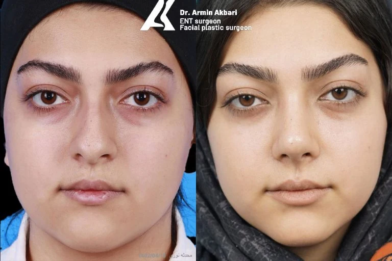 Rhinoplasty before and after comparison, example 22, published by Dr Armin Akbari