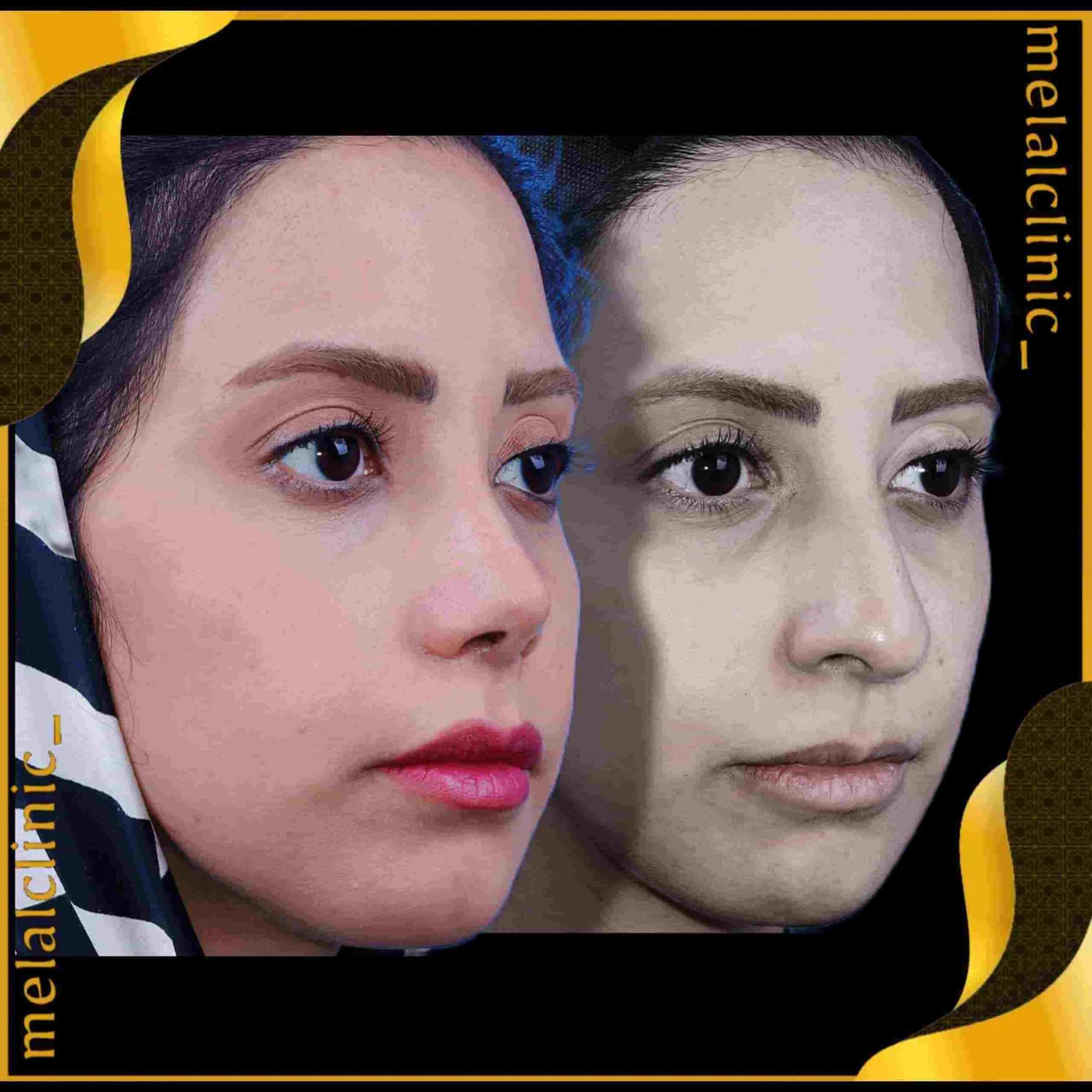 Rhinoplasty before and after comparison, example 23, published by Melal Clinic