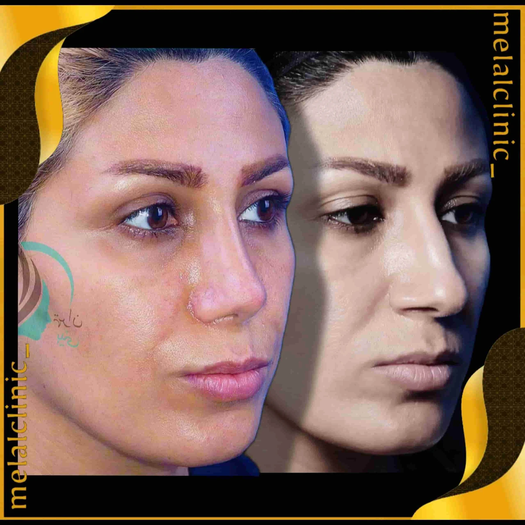Rhinoplasty before and after comparison, example 24, published by Melal Clinic
