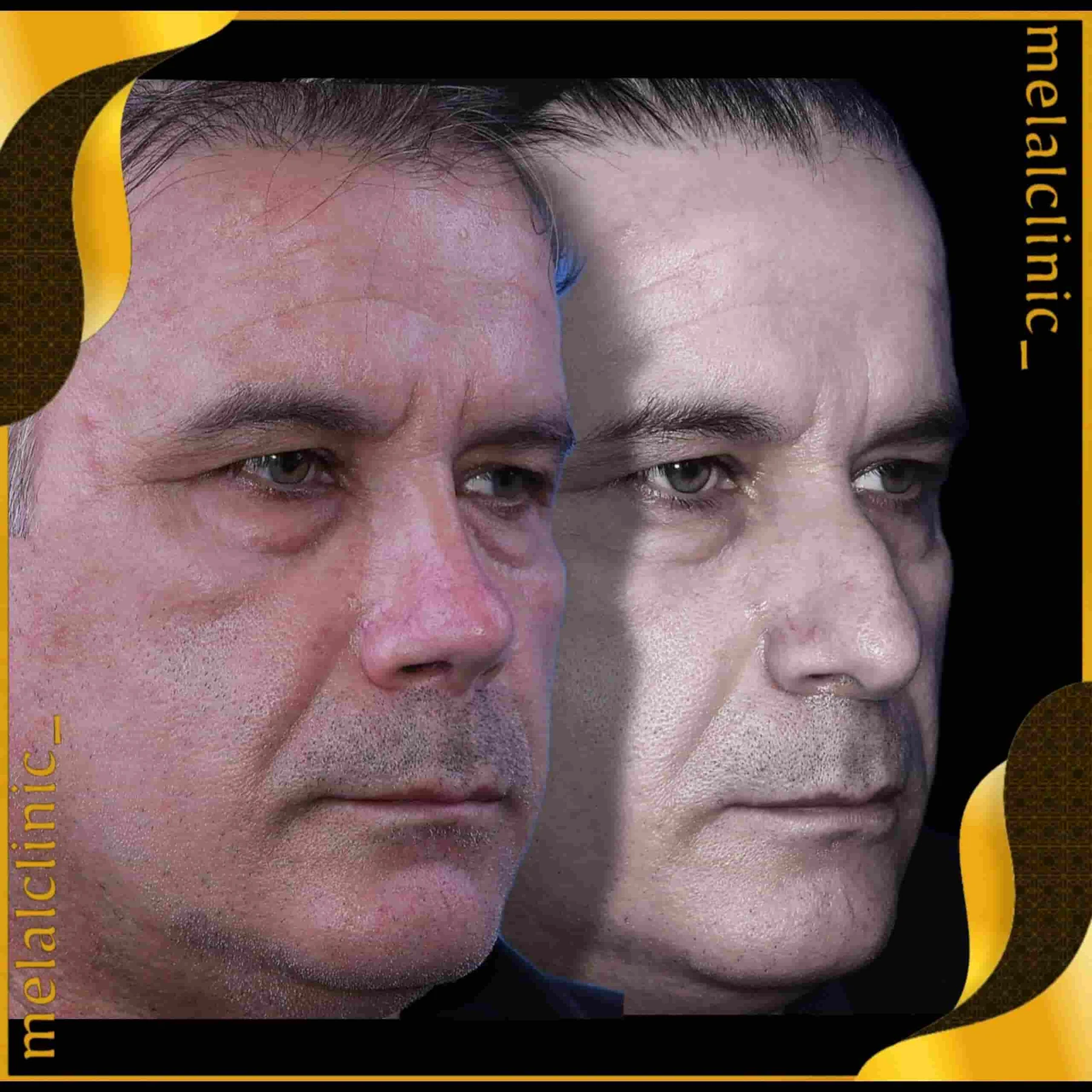 Rhinoplasty before and after comparison, example 25, published by Melal Clinic