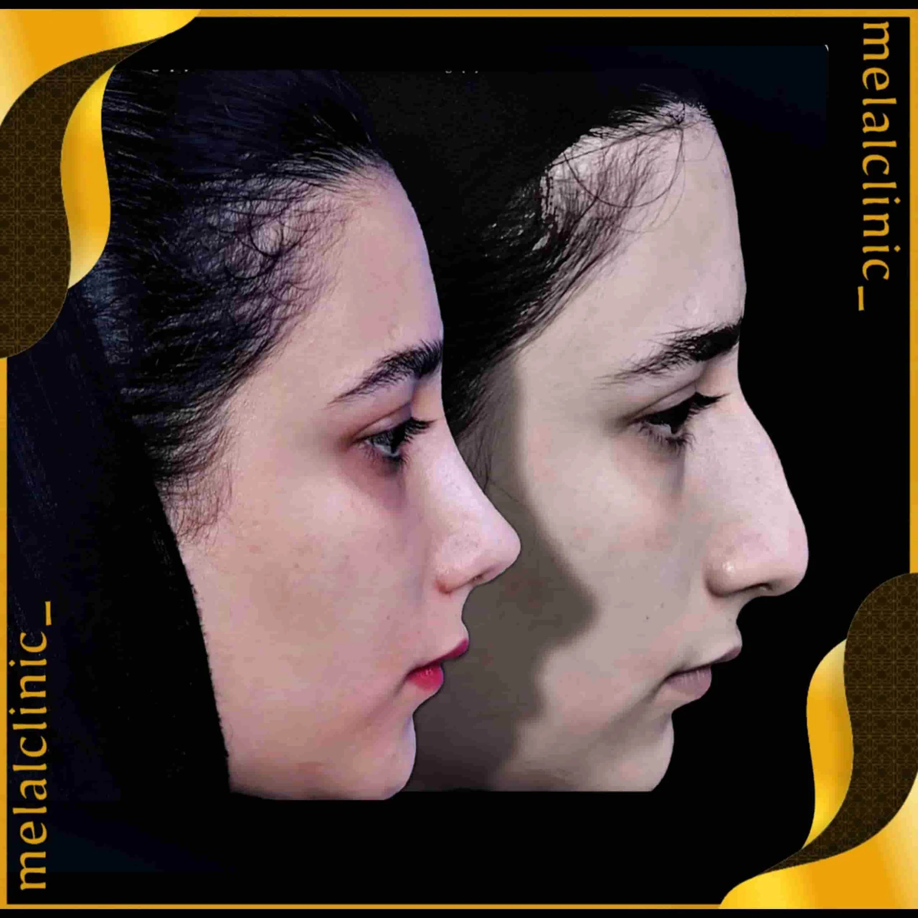 Rhinoplasty before and after comparison, example 26, published by Melal Clinic