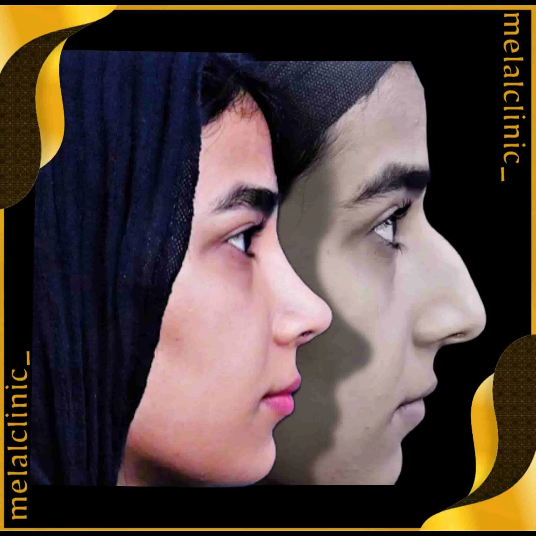 Rhinoplasty before and after comparison, example 27, published by Melal Clinic