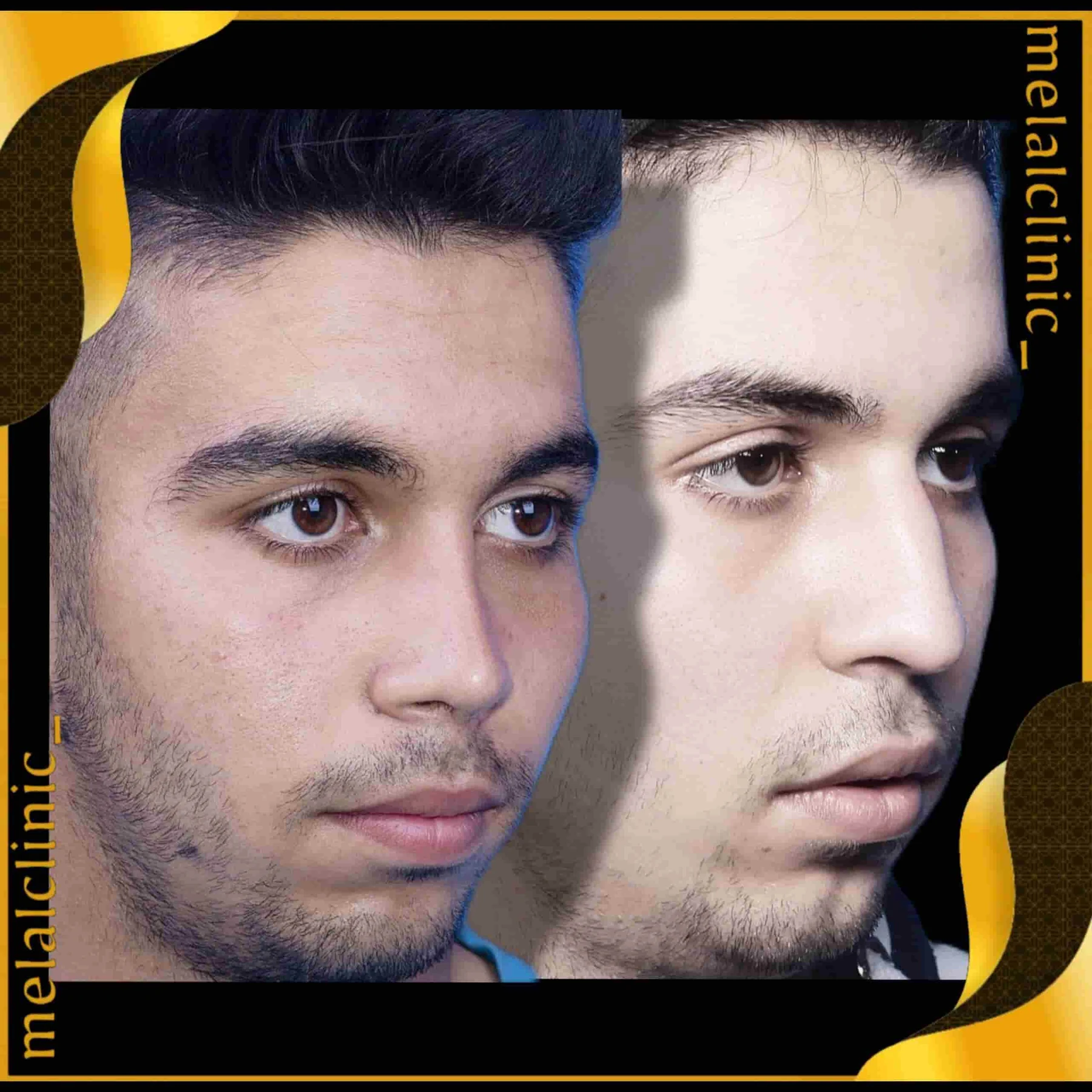 Rhinoplasty before and after comparison, example 28, published by Melal Clinic