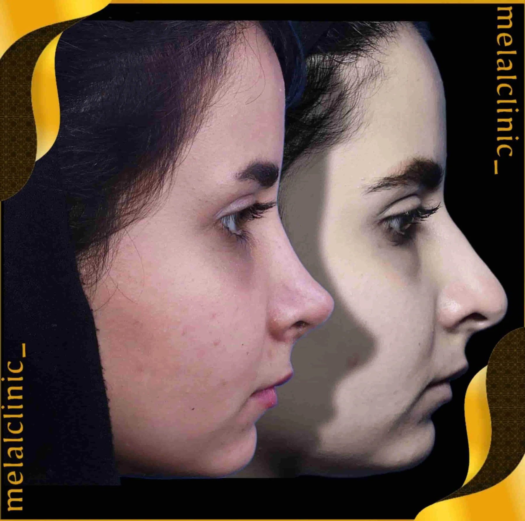 Rhinoplasty before and after comparison, example 29, published by Melal Clinic
