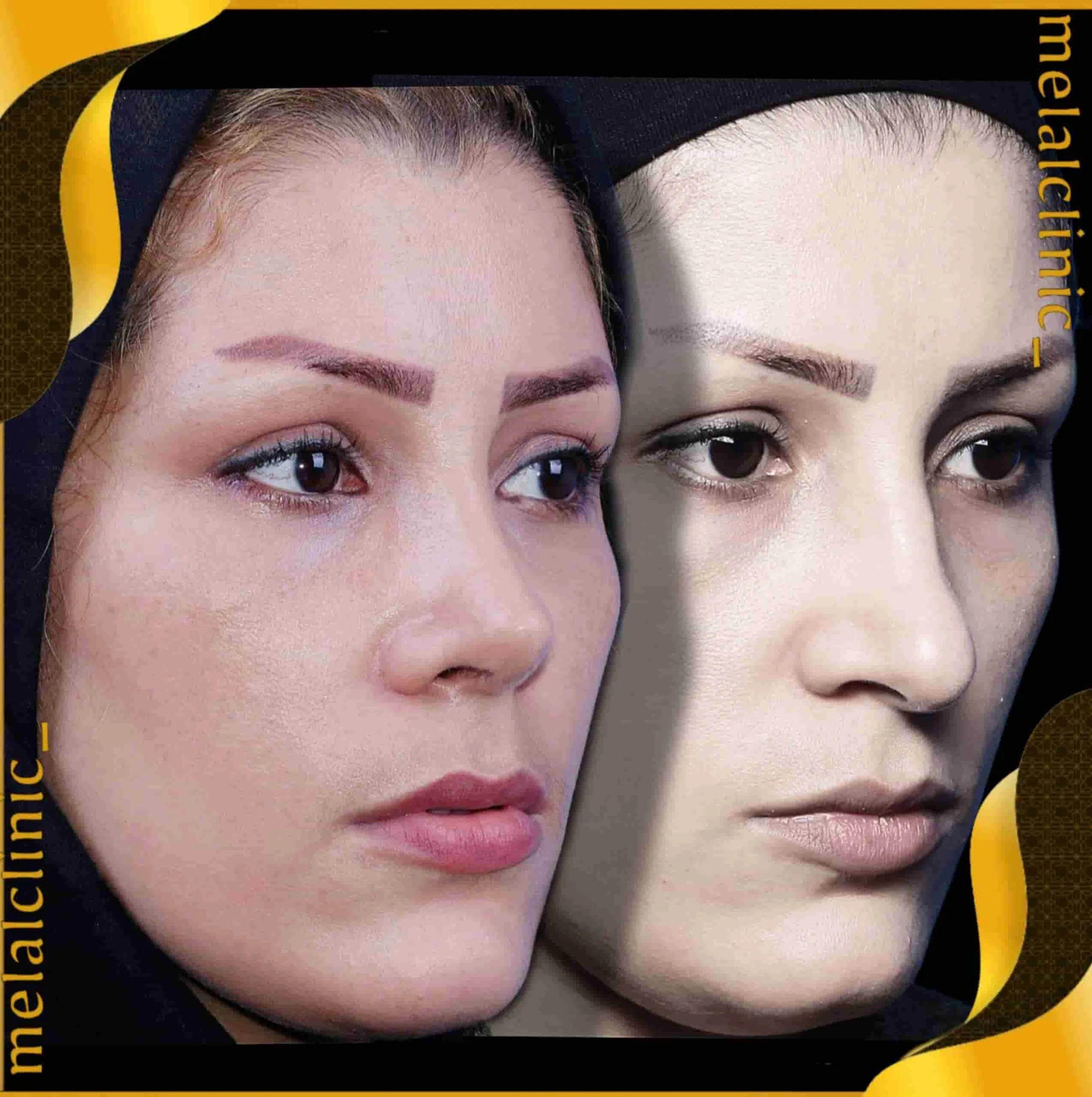 Rhinoplasty before and after comparison, example 30, published by Melal Clinic