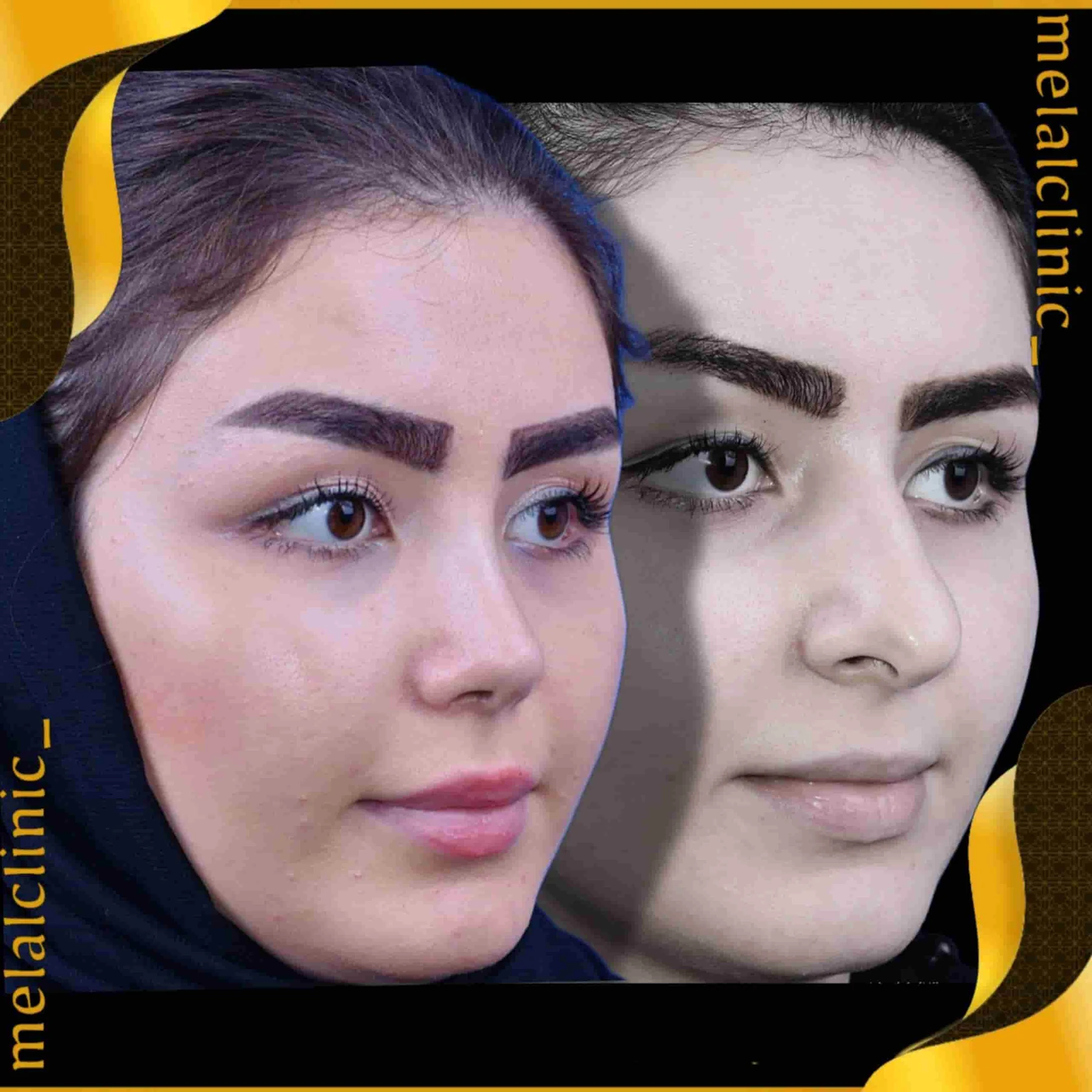 Rhinoplasty before and after comparison, example 31, published by Melal Clinic