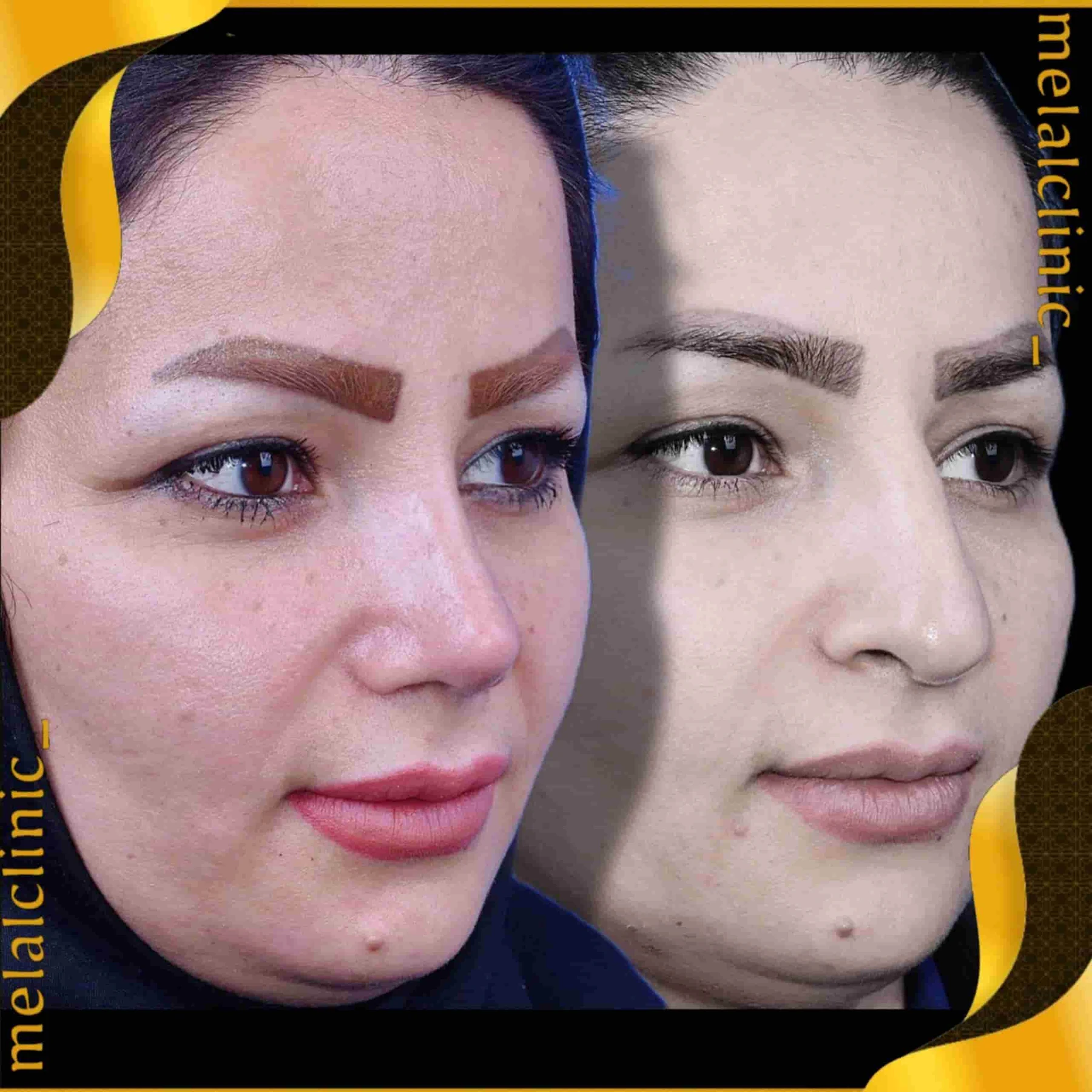 Rhinoplasty before and after comparison, example 32, published by Melal Clinic
