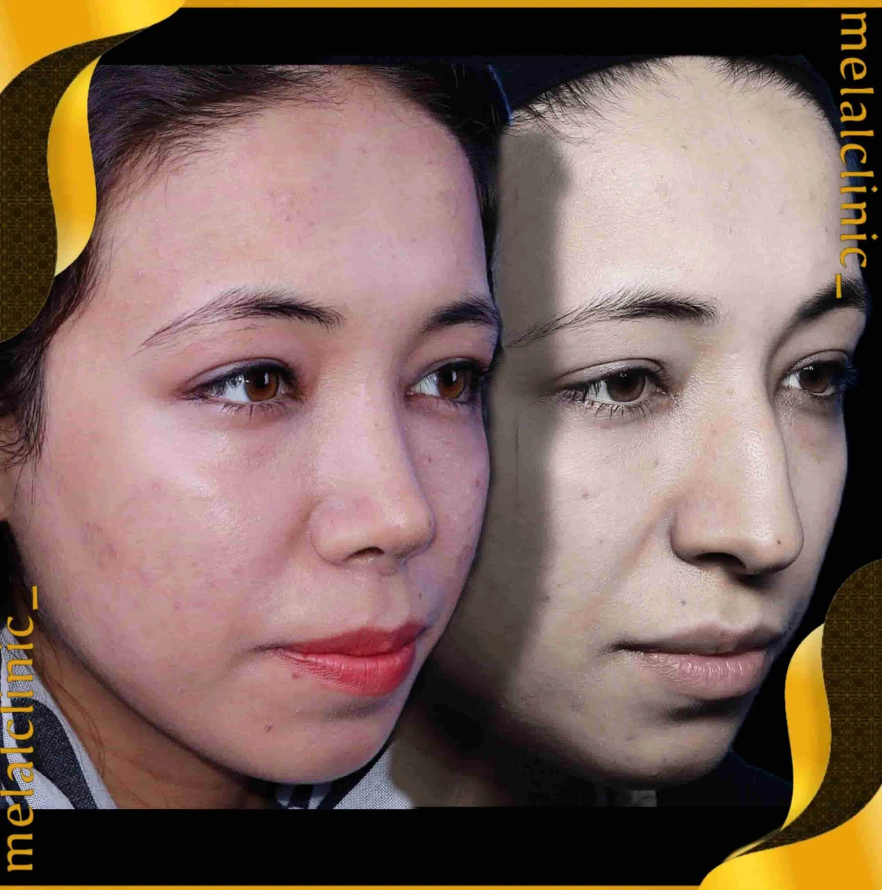 Rhinoplasty before and after comparison, example 33, published by Melal Clinic