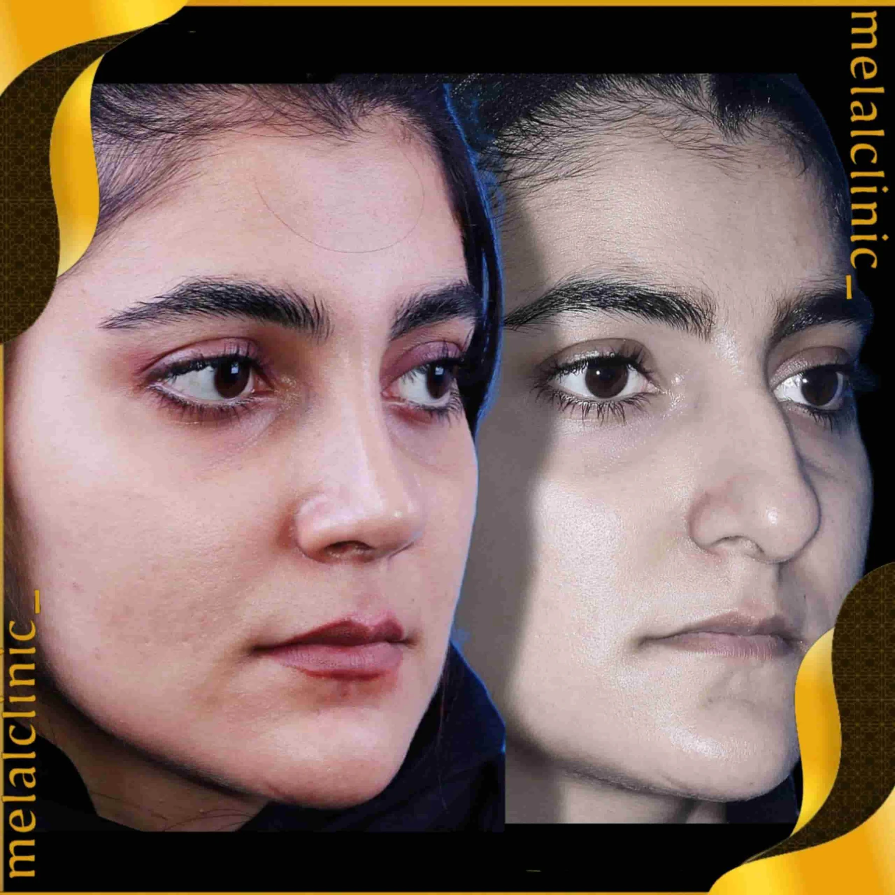 Rhinoplasty before and after comparison, example 34, published by Melal Clinic