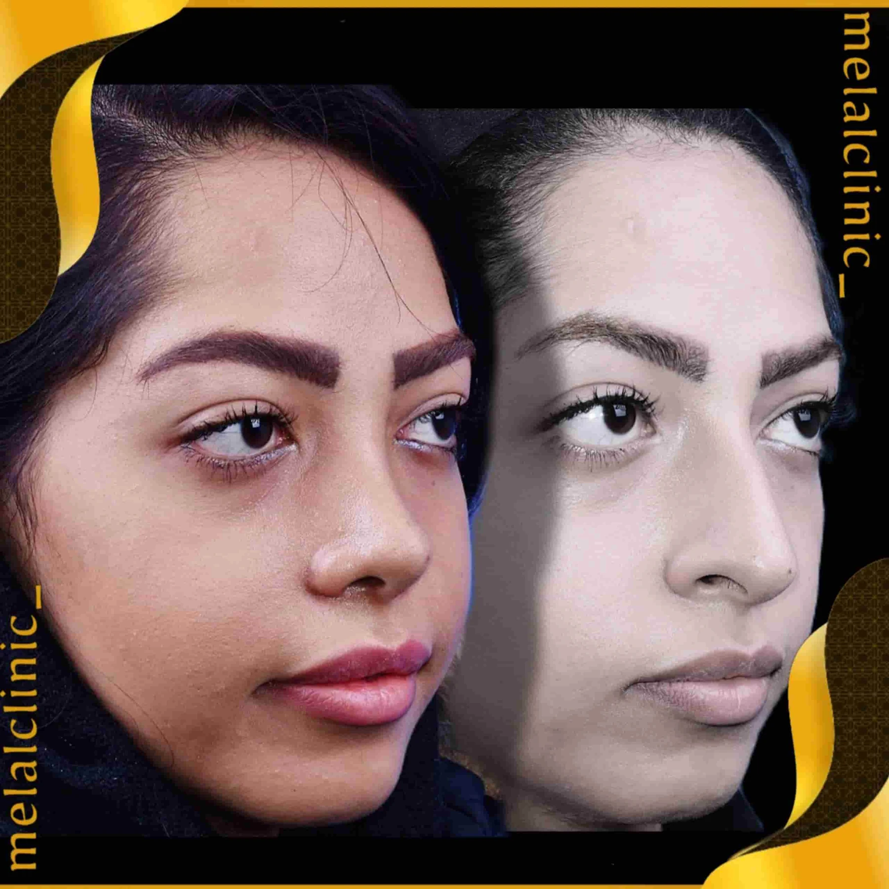 Rhinoplasty before and after comparison, example 35, published by Melal Clinic