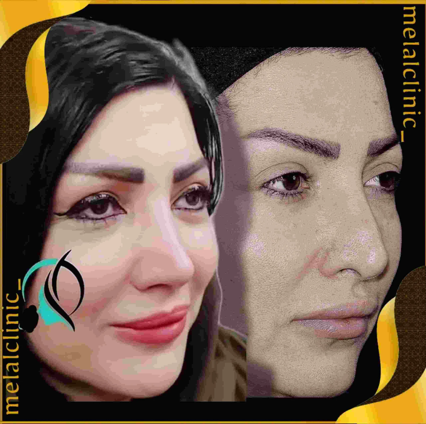 Rhinoplasty before and after comparison, example 36, published by Melal Clinic