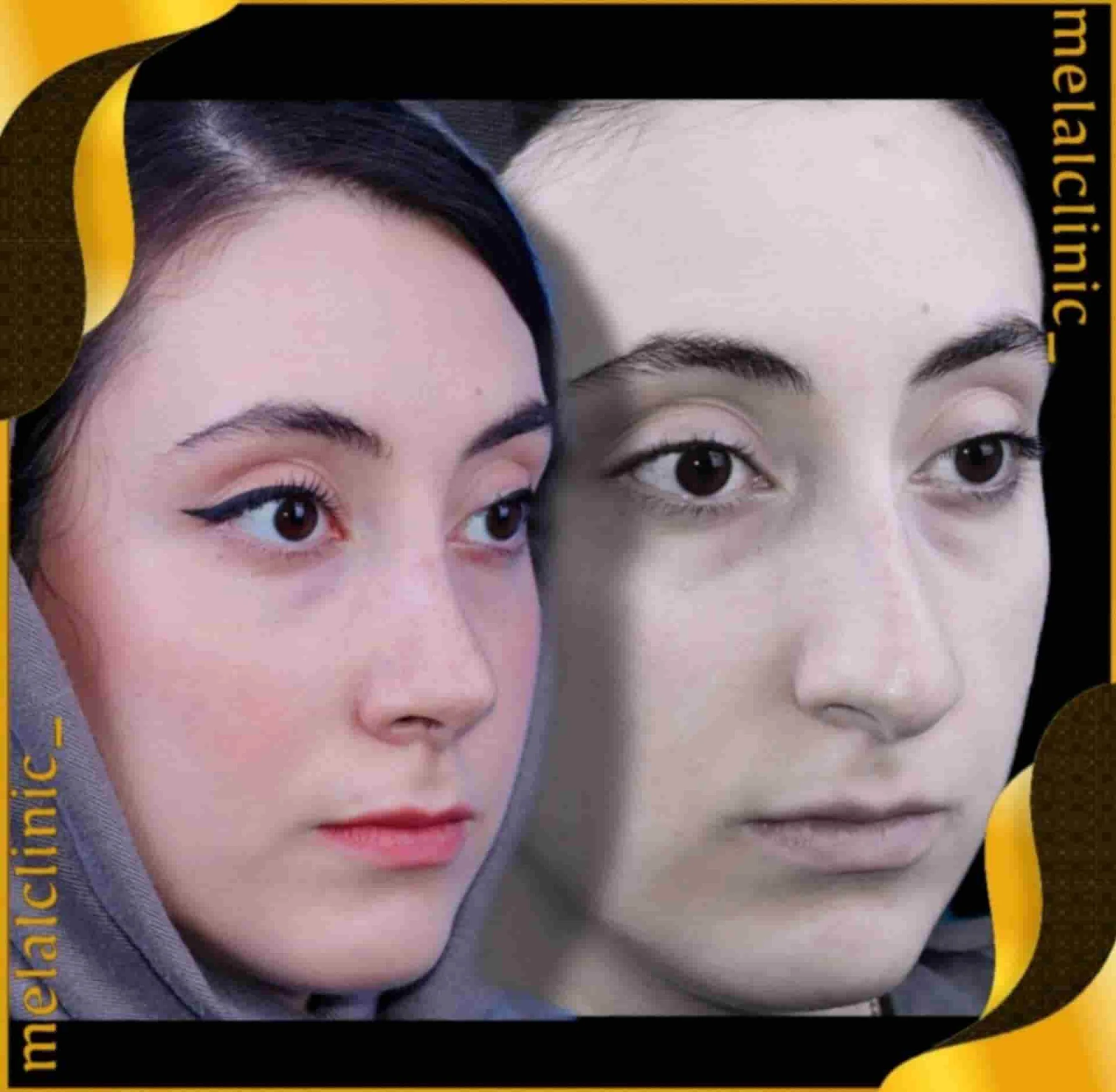 Rhinoplasty before and after comparison, example 37, published by Melal Clinic
