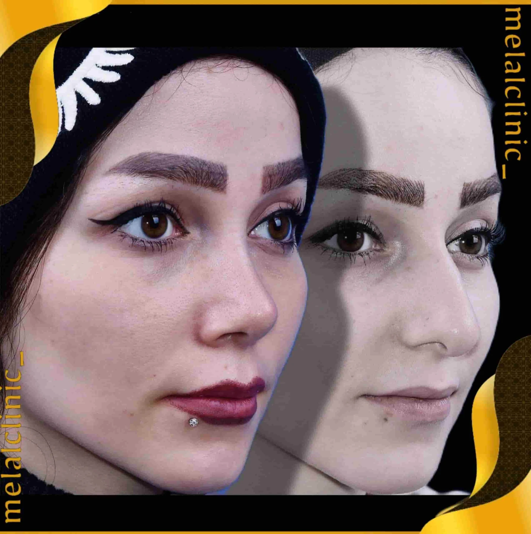 Rhinoplasty before and after comparison, example 38, published by Melal Clinic