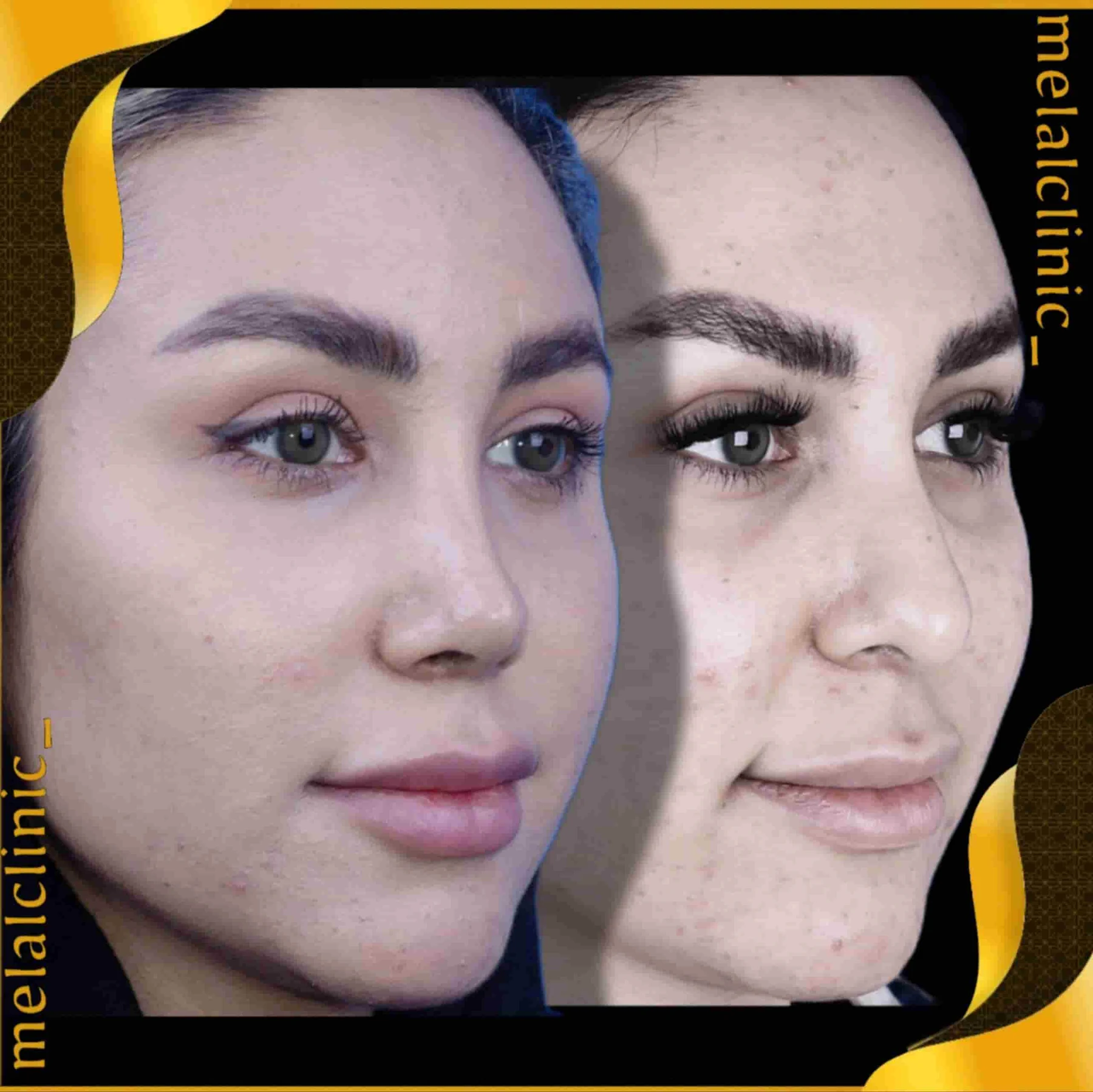 Rhinoplasty before and after comparison, example 39, published by Melal Clinic