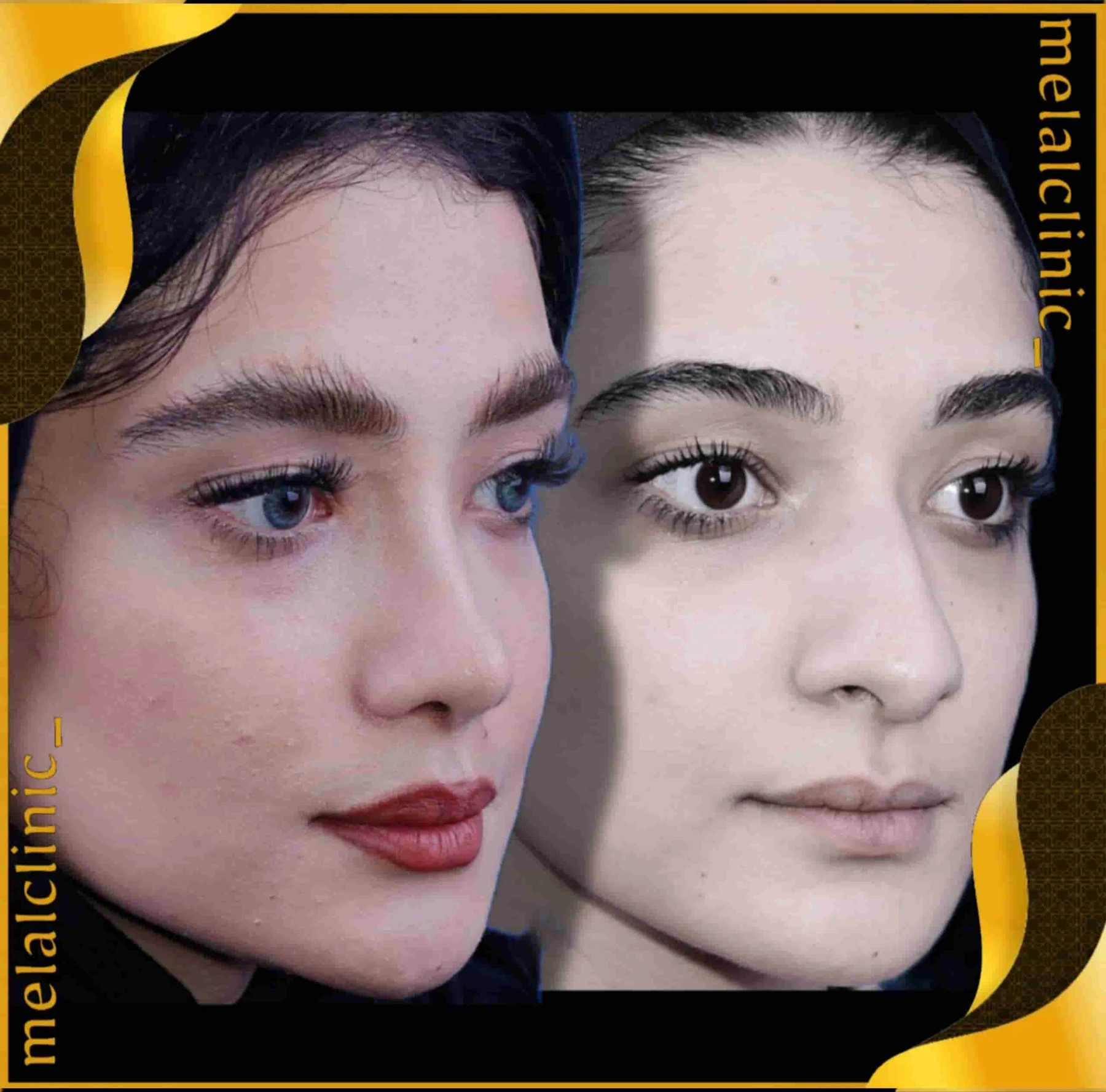 Rhinoplasty before and after comparison, example 40, published by Melal Clinic
