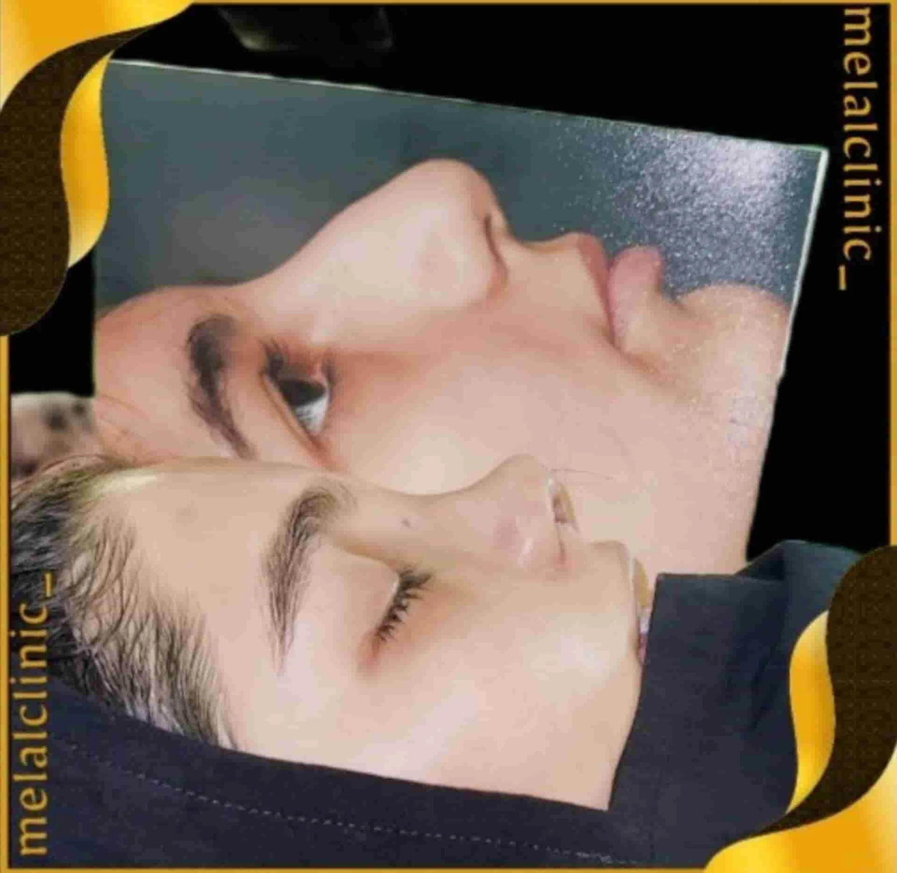 Rhinoplasty before and after comparison, example 41, published by Melal Clinic