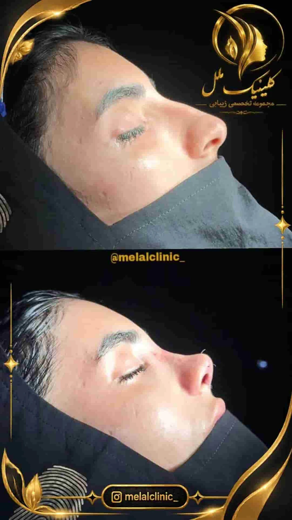 Rhinoplasty before and after comparison, example 42, published by Melal Clinic