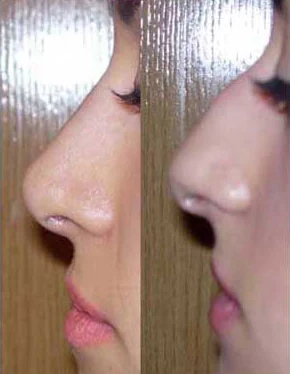 Rhinoplasty before and after comparison, example 43, published by Dr Hooman Farhang Majd