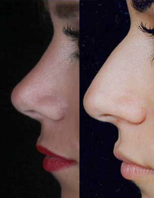Rhinoplasty before and after comparison, example 44, published by Dr Hooman Farhang Majd