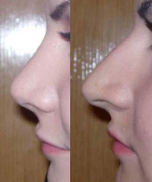 Rhinoplasty before and after comparison, example 45, published by Dr Hooman Farhang Majd