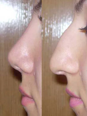 Rhinoplasty before and after comparison, example 46, published by Dr Hooman Farhang Majd