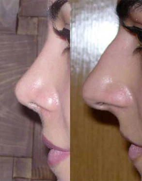 Rhinoplasty before and after comparison, example 47, published by Dr Hooman Farhang Majd