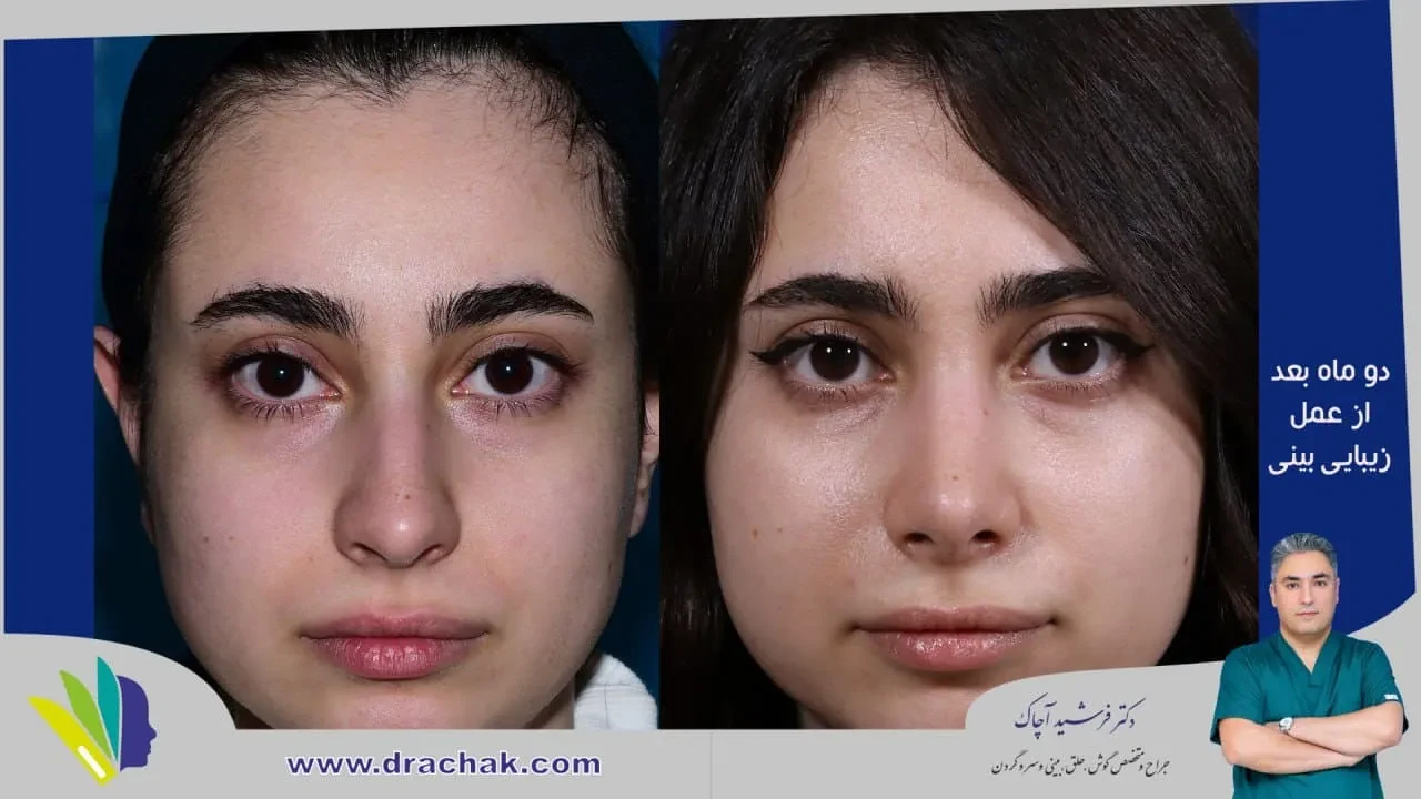 Rhinoplasty before and after comparison, example 48, published by Dr Farshid Achak