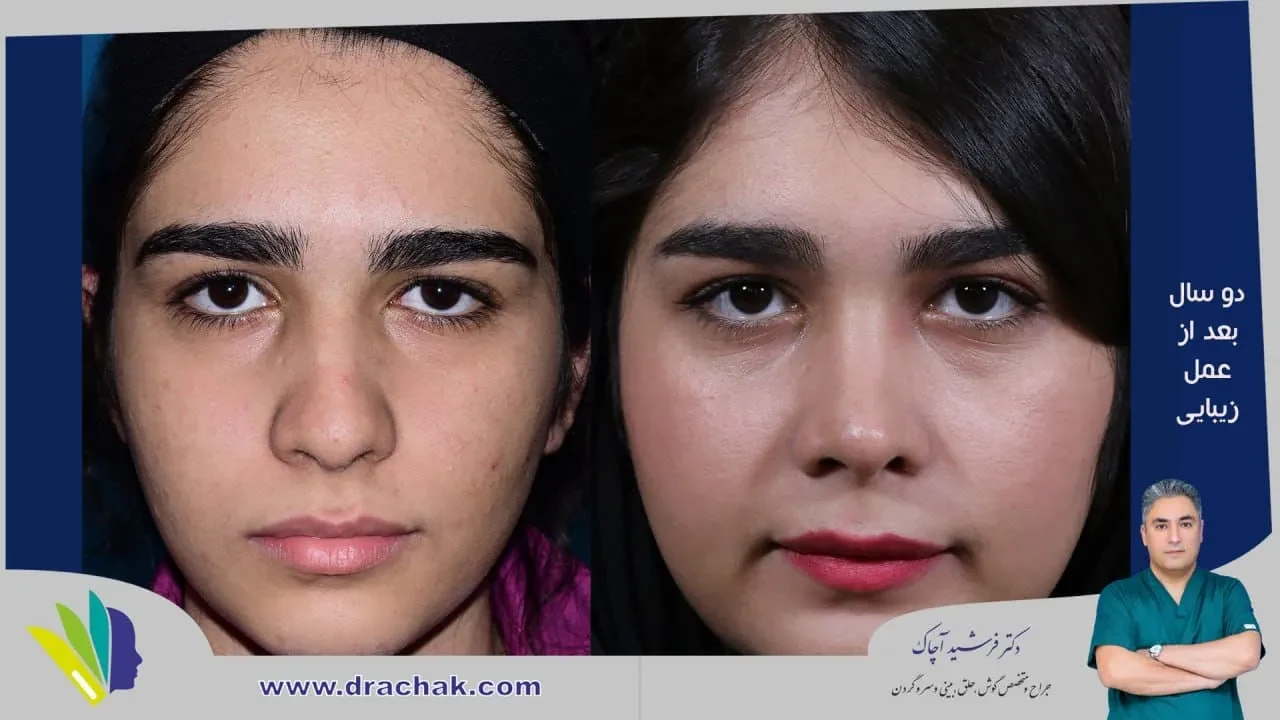 Rhinoplasty before and after comparison, example 49, published by Dr Farshid Achak