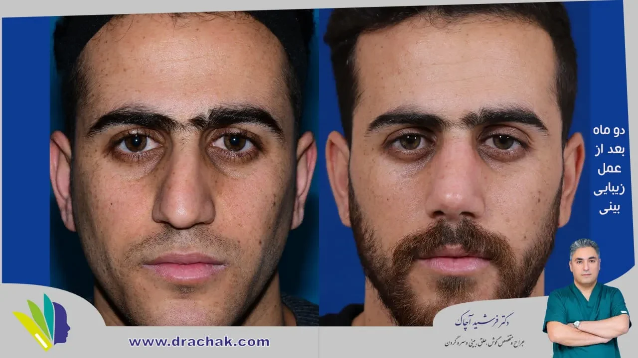 Rhinoplasty before and after comparison, example 50, published by Dr Farshid Achak