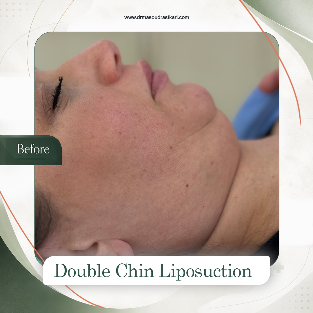 Submental liposuction, case 1 before treatment, Dr Masoud Rastkari