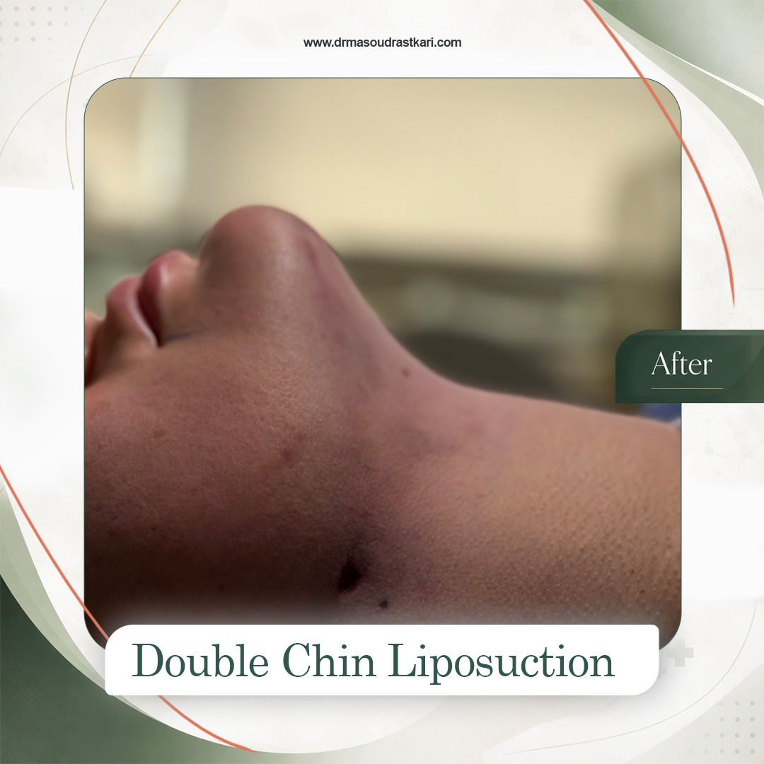 Submental liposuction, case 1 after treatment, Dr Masoud Rastkari
