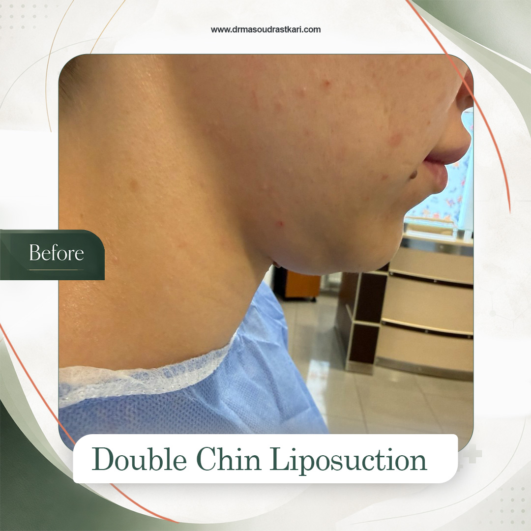 Submental liposuction, case 2 before treatment, Dr Masoud Rastkari