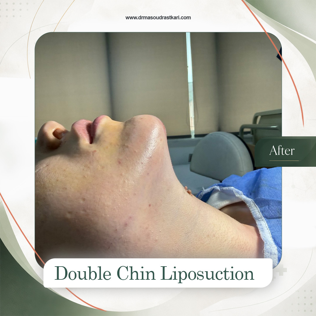 Submental liposuction, case 2 after treatment, Dr Masoud Rastkari