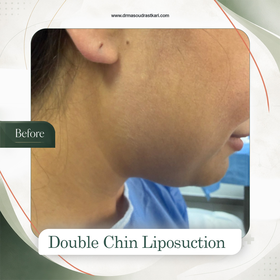 Submental liposuction, case 3 before treatment, Dr Masoud Rastkari