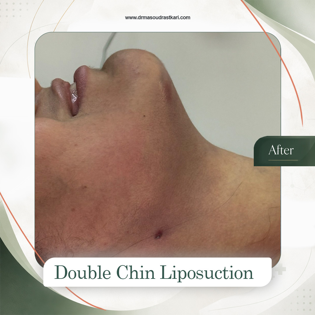 Submental liposuction, case 3 after treatment, Dr Masoud Rastkari