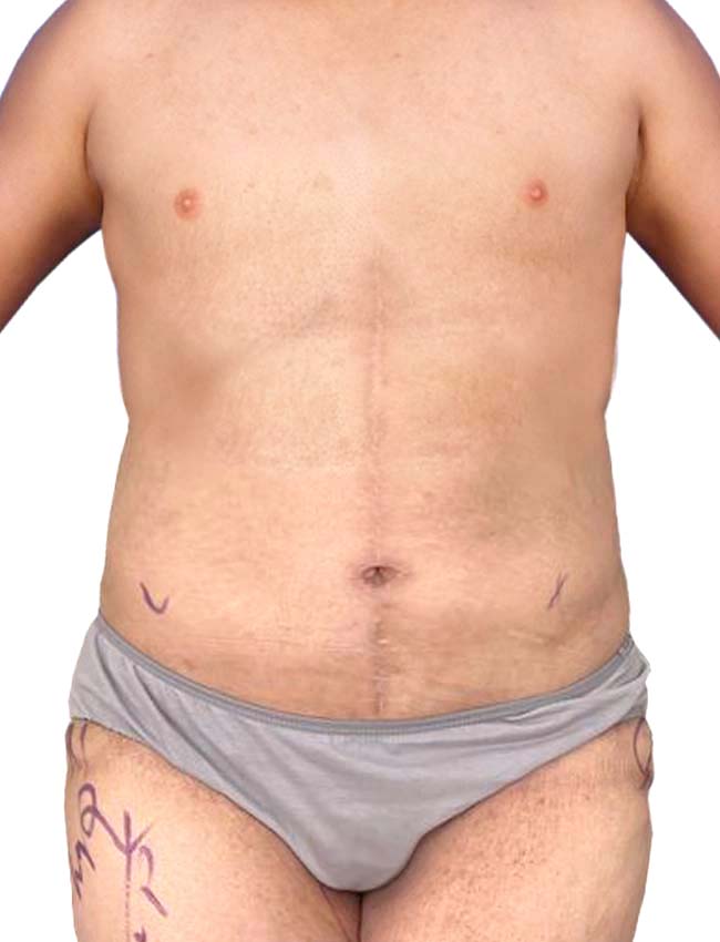 Abdominoplasty comparison after treatment, Dr Alireza Ghaseminejad