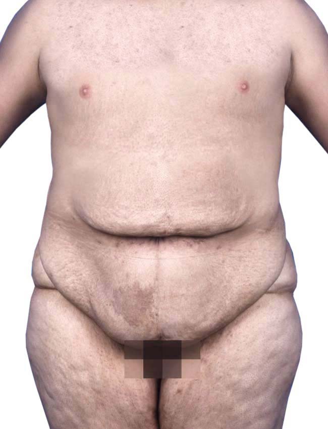 Abdominoplasty comparison before treatment, Dr Alireza Ghaseminejad