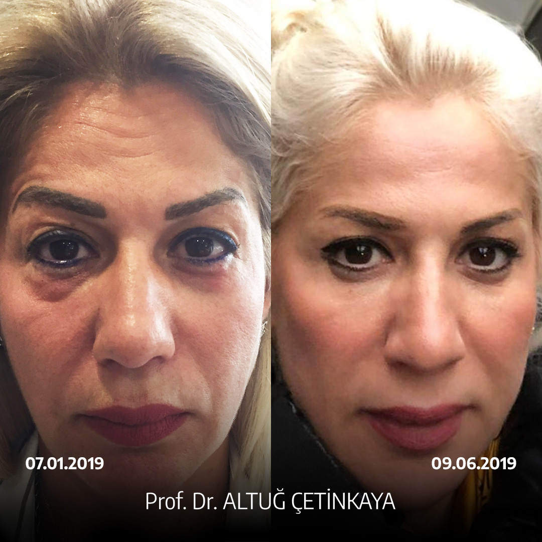 Turkey blepharoplasty example from Prof. Dr. Altug Cetinkaya case 1
