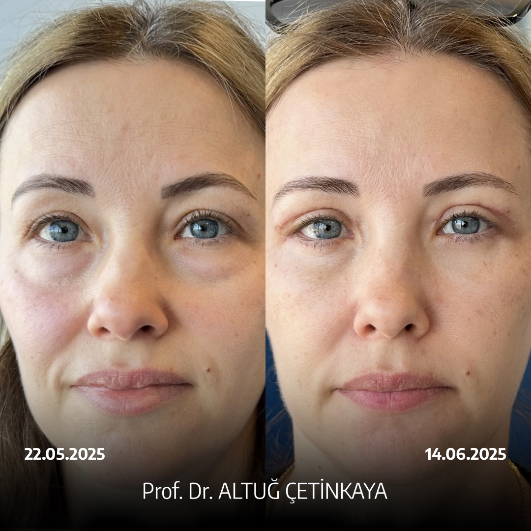 Turkey blepharoplasty example from Prof. Dr. Altug Cetinkaya case 2