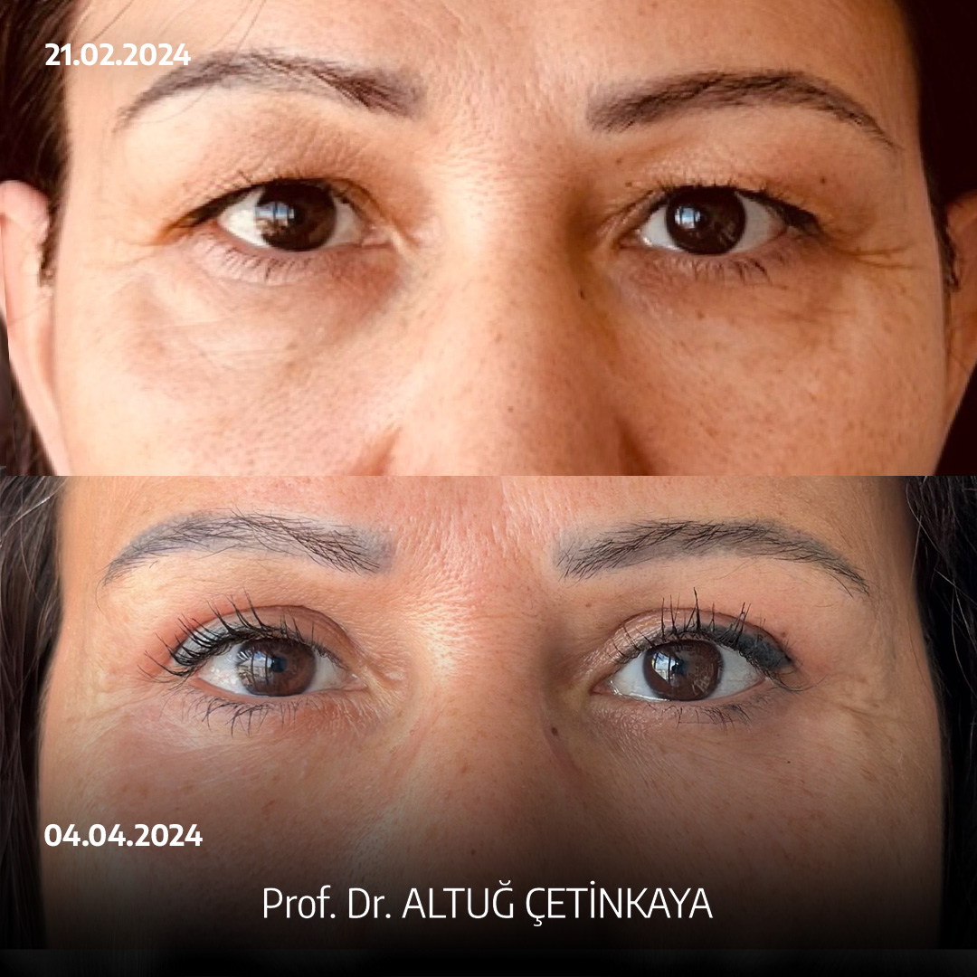 Turkey blepharoplasty example from Prof. Dr. Altug Cetinkaya case 3